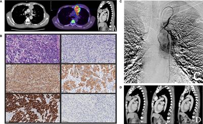 Mediastinal Hepatoid Adenocarcinoma Treated With Arterial Interventional Therapy: A Case Report and Review of Literature